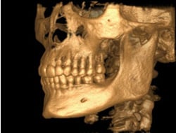 3-D Implant Imaging