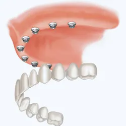 Cape fear perio offers Dental Implants