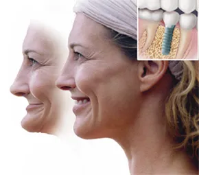 Dental Implants for Cape Fear Perio