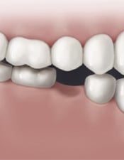 Dental Implants for Cape Fear Perio