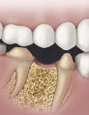 Dental Implants Cape Fear Perio