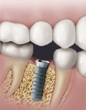 Dental Implant Treatments