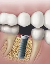 Dental Implant Treatments