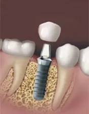 Dental Implants process