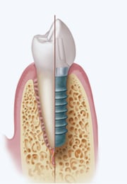 Dental Implants examples