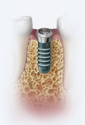 Dental Implants