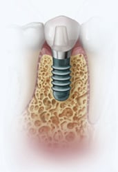 Dental Implants