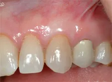 Gum Grafting with Cape Fear Period