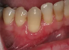 Gum Grafting with Cape Fear Period