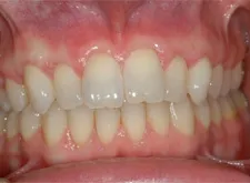 Gum Grafting with Cape Fear Period