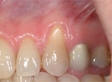 Gum Grafting with Dr.Gould