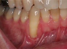 Gum Grafting with Dr.Gould