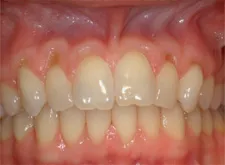 Gum Grafting with Dr.Gould