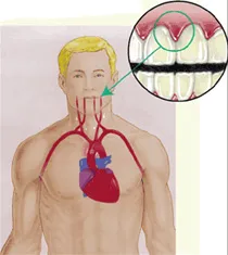 About Periodontal Disease